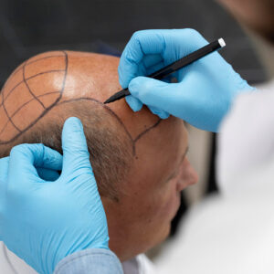 3-Day Basic FUE Hair Transplant Workshop
